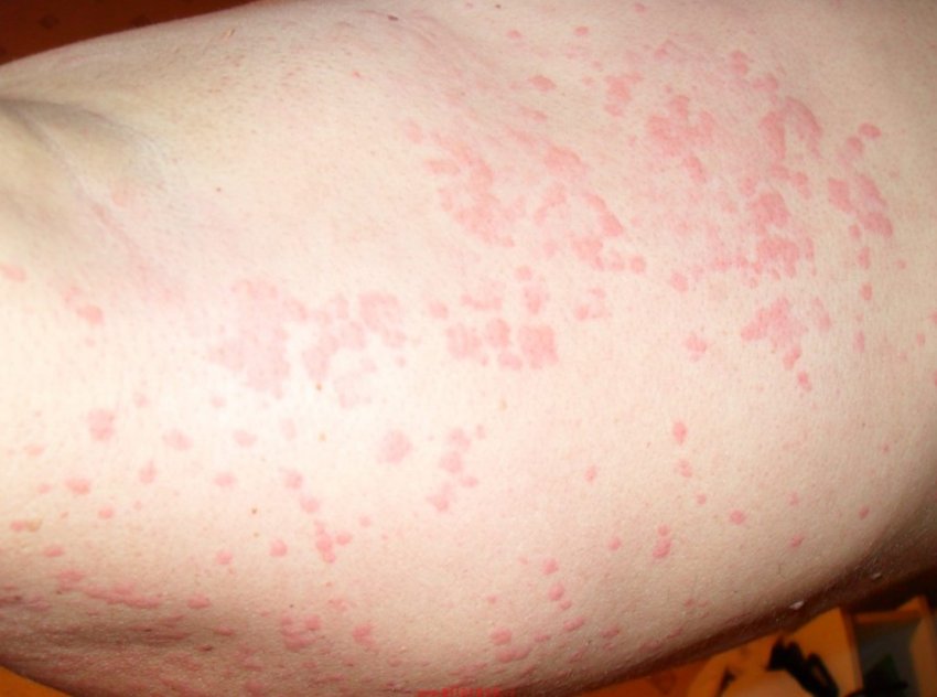 Алергічна кропив'янка Алергічна кропив'янка
