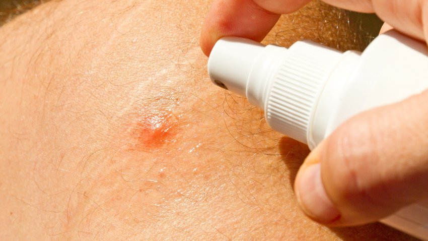 Перша допомога при укусі бджоли