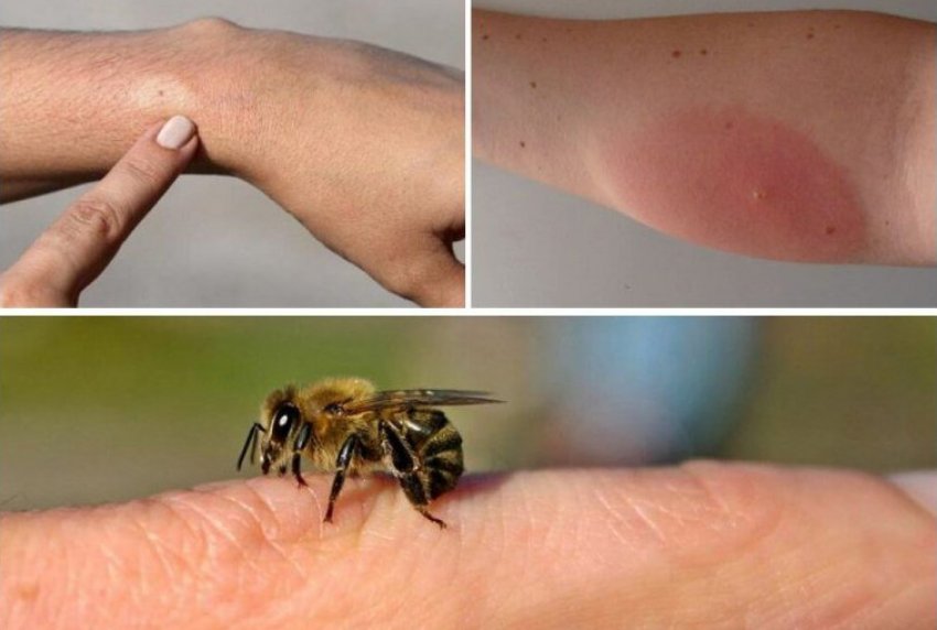 Наслідки укусу бджоли