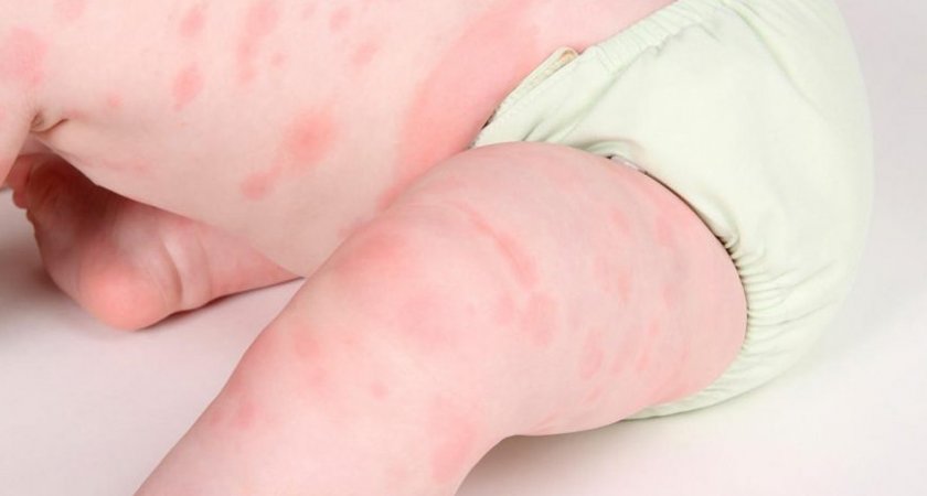 Аллергия на красный лук у грудничка thumbnail