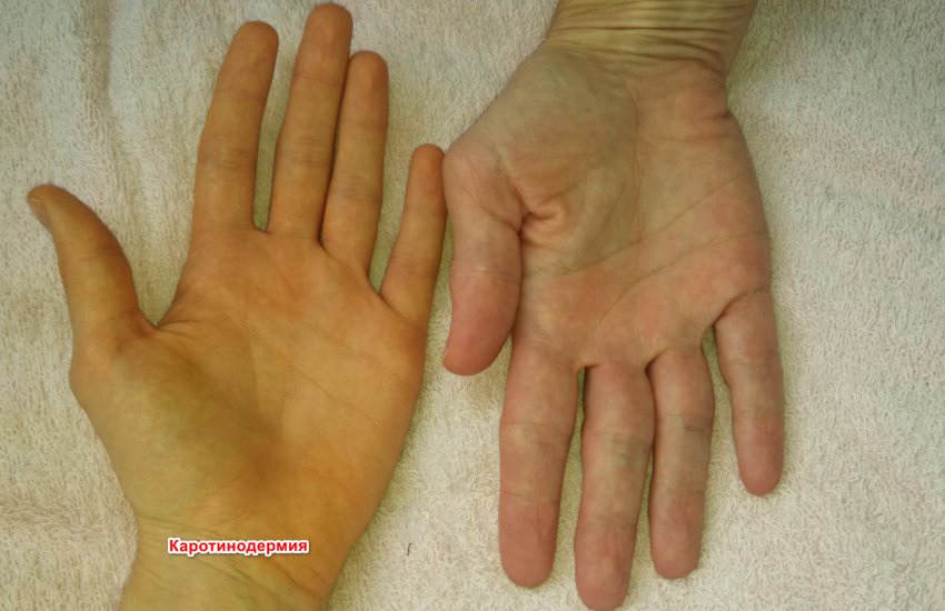 Каротинодермия Каротинодермия
