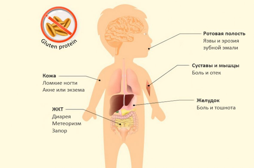 Симптоми непереносимості глютену Симптоми непереносимості глютену