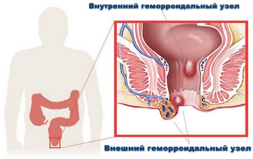 Геморрой