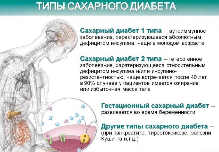 Типи цукрового діабету Типи цукрового діабету