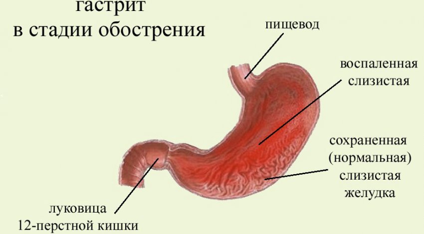 Гастрит во время обострения