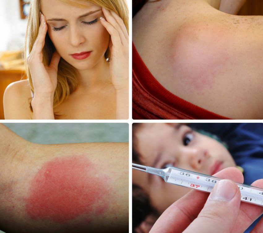 Реакція на укус джмеля Реакція на укус джмеля