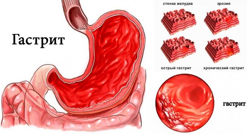 Гастрит