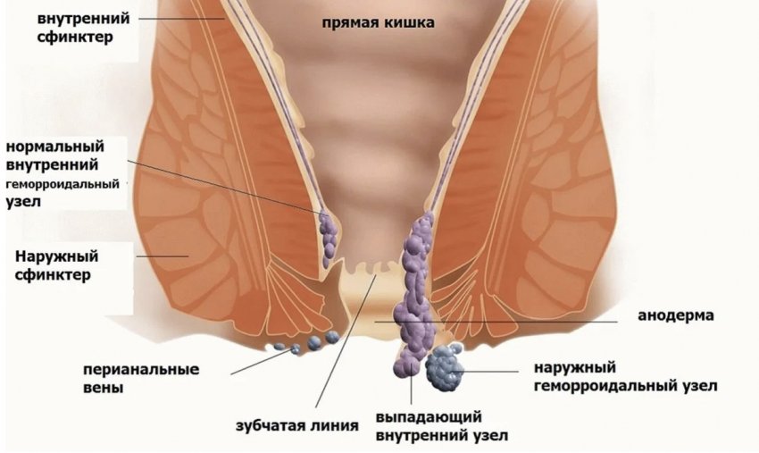 Що таке гемморой Що таке гемморой