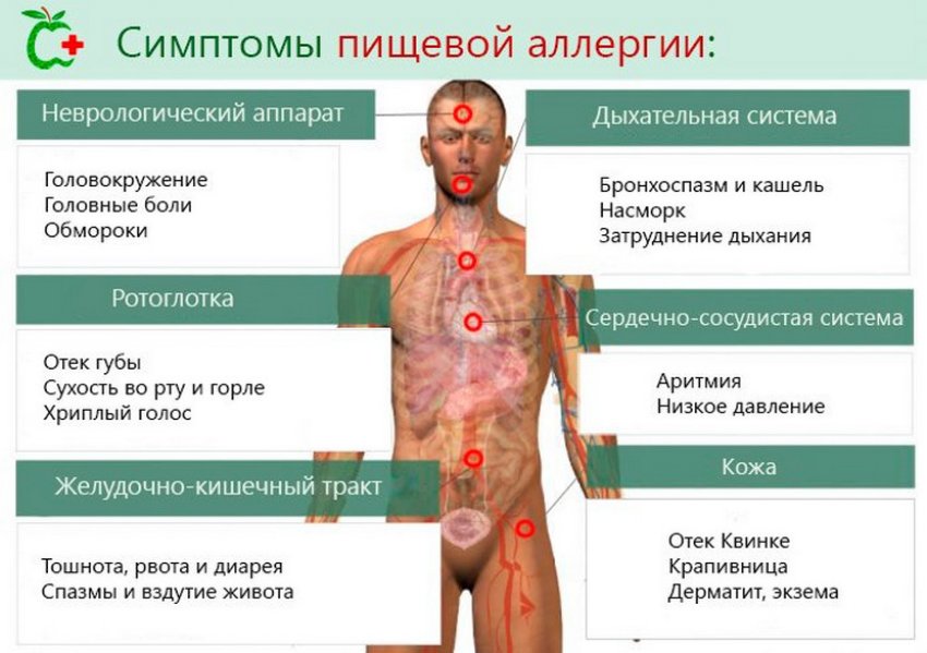 Симптоми харчової алергії Симптоми харчової алергії