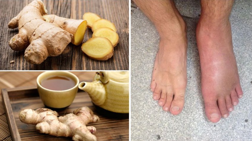 Імбир при подагрі Імбир при подагрі
