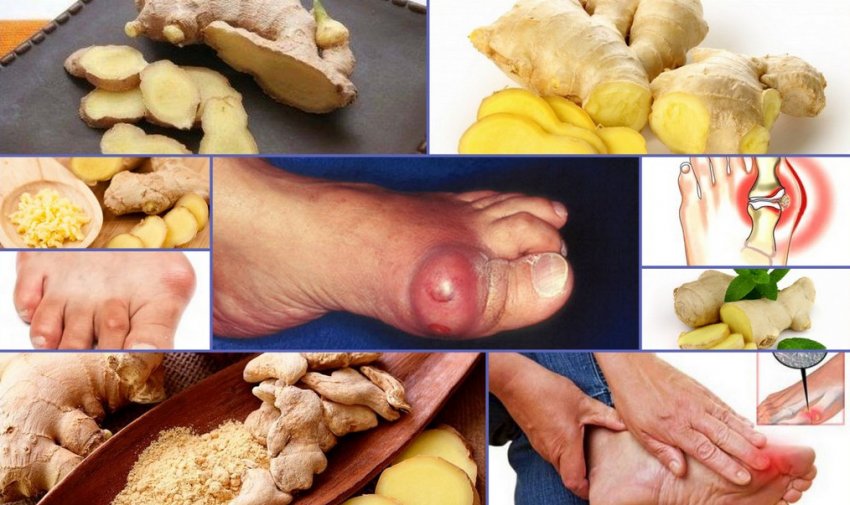 Імбир при подагрі Імбир при подагрі