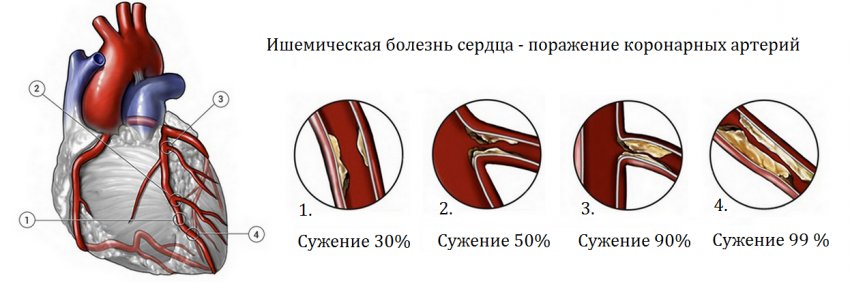 Що таке ішемічна хвороба серця