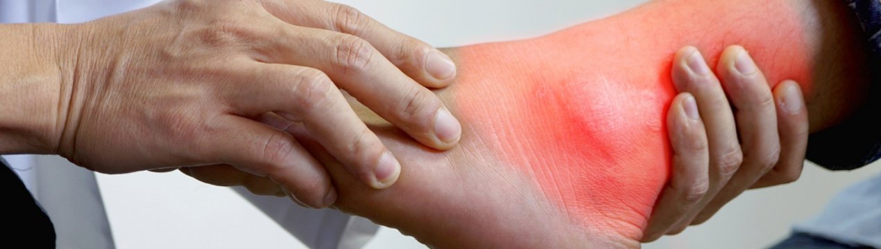 Чи є імбир при подагрі