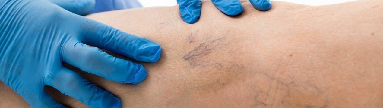 Корінь імбиру при варикозному розширенні вен: допомагає чи, правила вживання