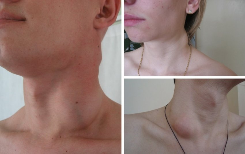 Лимфоденопатия Лимфоденопатия