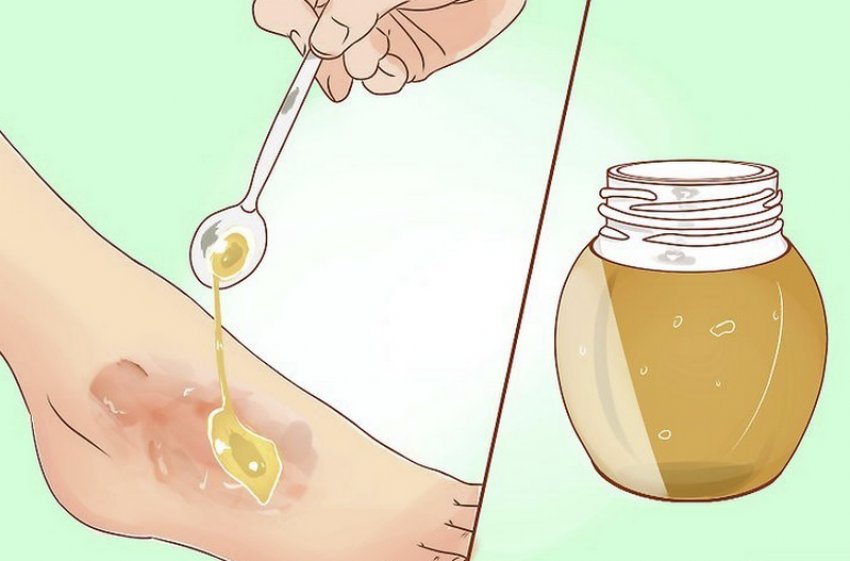 Лечение ран мёдом