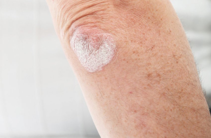 Імбир при псоріазі