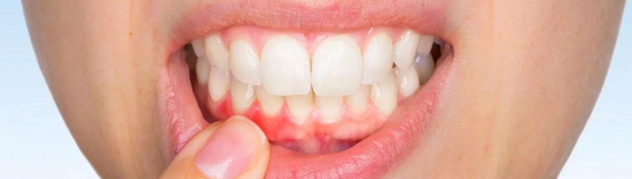 Імбир для лікування ясен і зубів