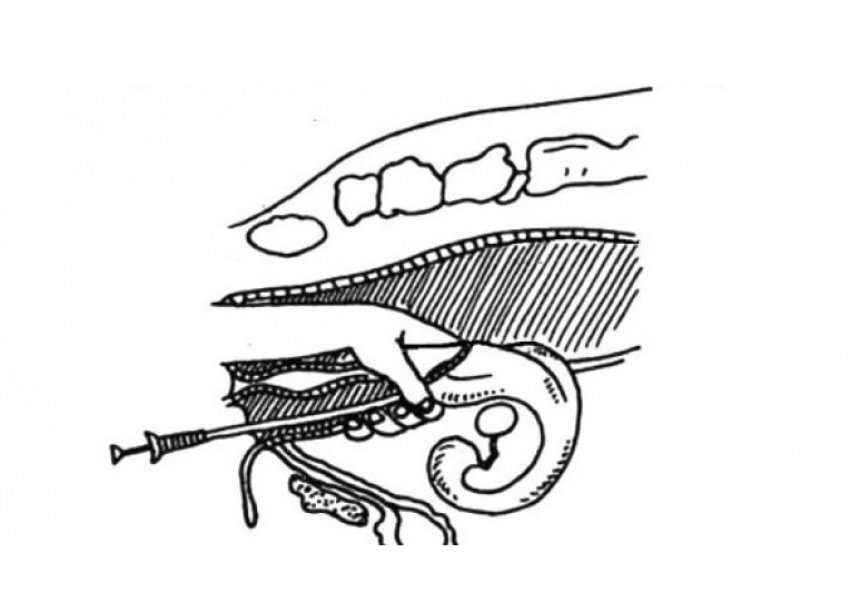 Ректоцервікальний способо осіменіння Ректоцервікальний способо осіменіння