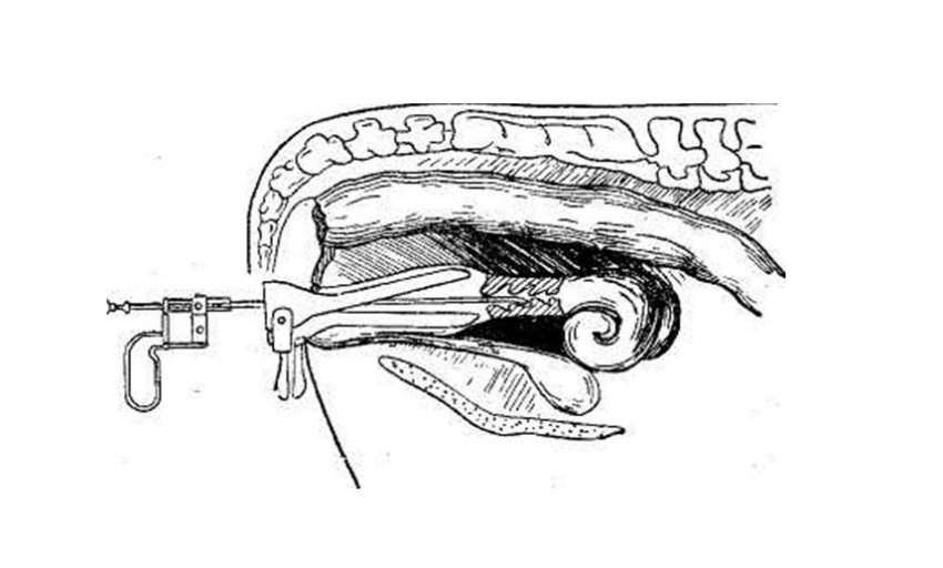 Маноцервікальний спосіб осіменіння Маноцервікальний спосіб осіменіння