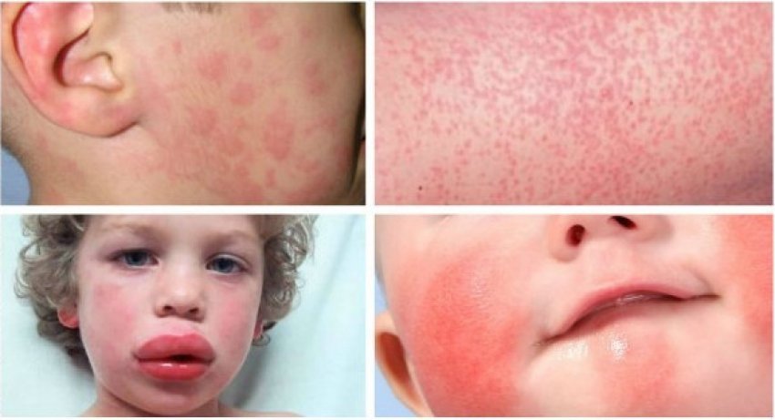 Аллергия Как Она Выглядит Фото