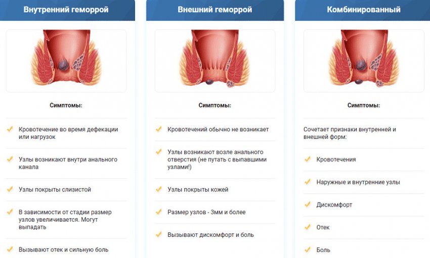 Виды геммороя