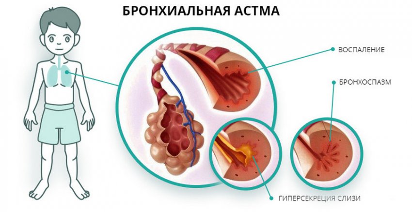 Бронхиальная астма