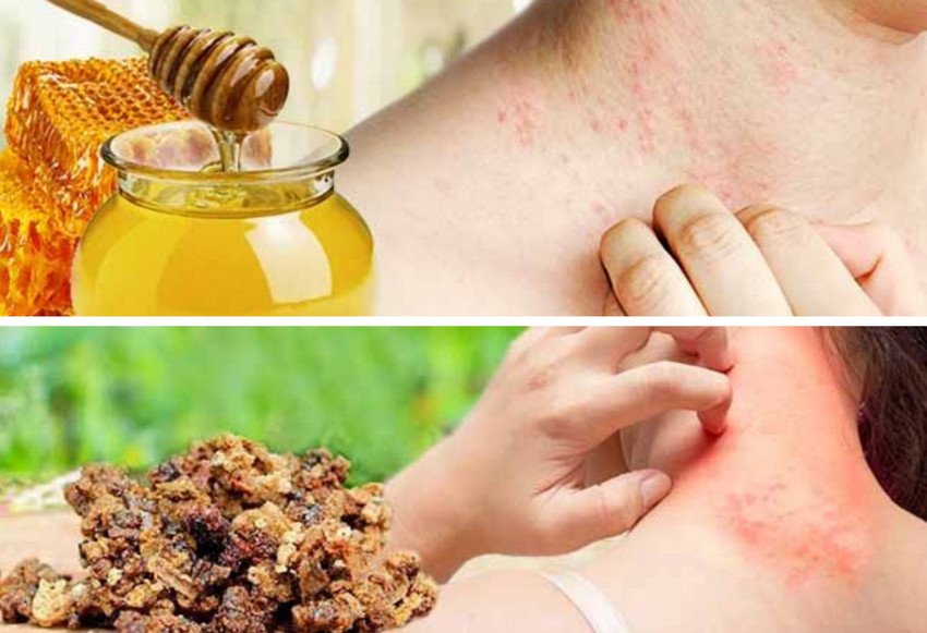 Аллергия на продукты пчеловодства