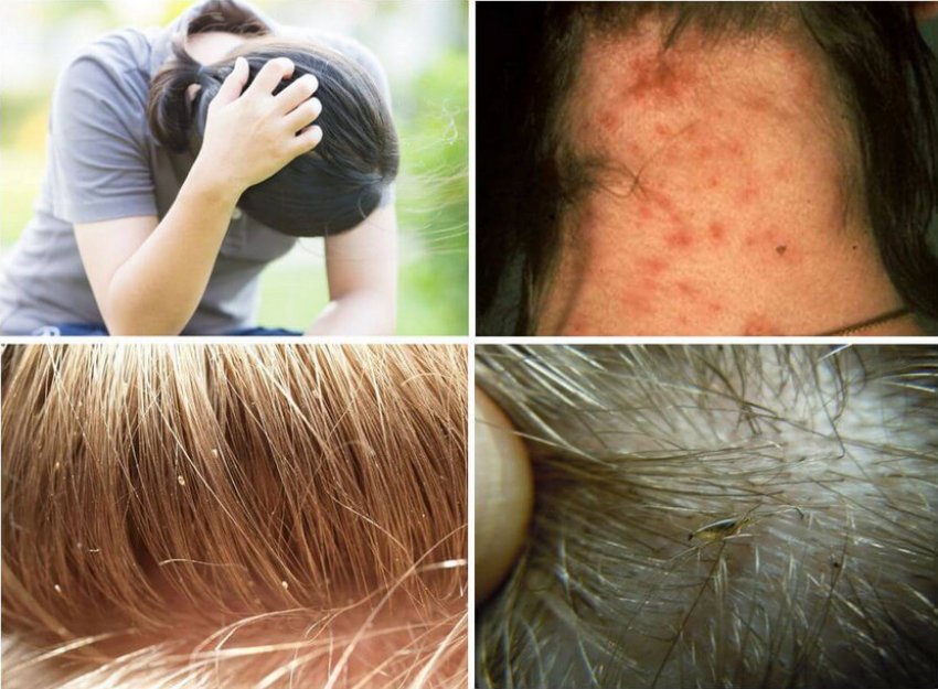 Педикульоз Педикульоз