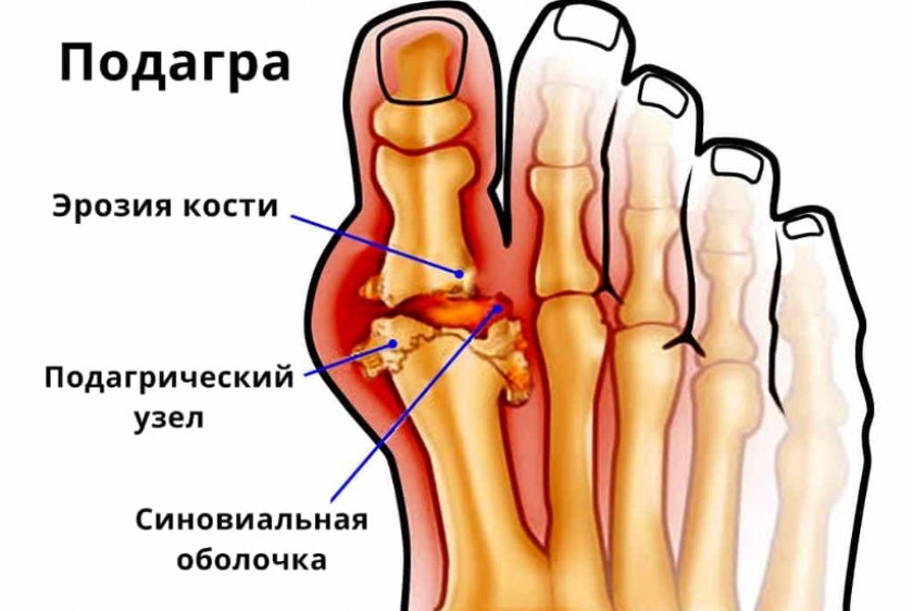 Подагра Подагра