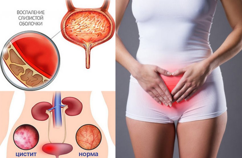 Цистит у жінок