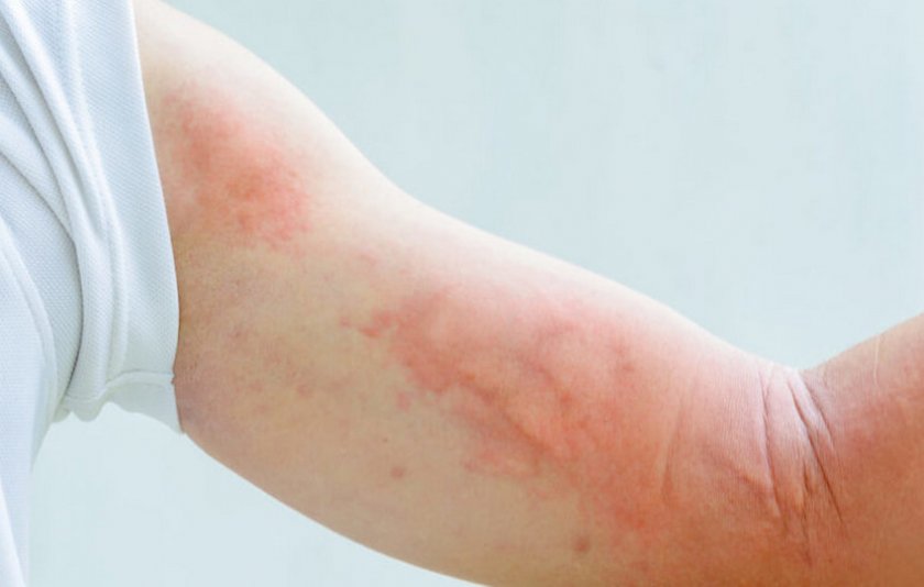 Аллергия на имбирь