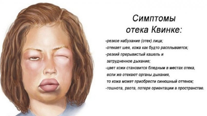 Отёк Квинке