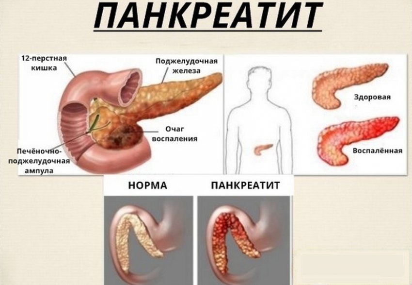 Панкреатит